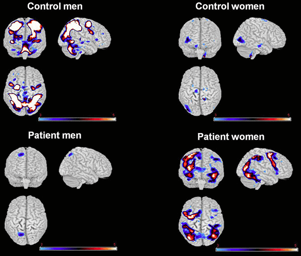 Différences dans les scintigraphies cérébrales entre les témoins et les personnes atteintes de schizophrénie