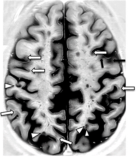 Ressonância magnética de um cérebro com esclerose múltipla