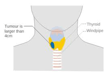 T3期の甲状腺がんを示す図。 
