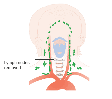 Schéma montrant après une chirurgie pour un cancer médullaire de la thyroïde 
