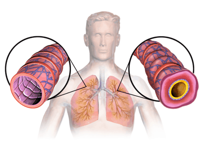 Gesunde und Asthma-Lunge