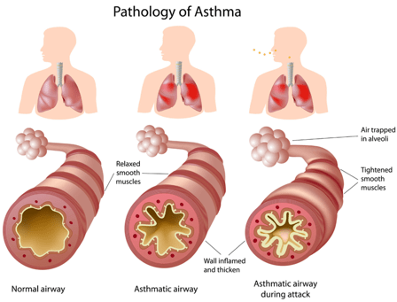 Pathologie von Asthma