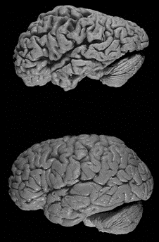 Ein Alzheimer-Gehirn im Vergleich zu einem gesunden Gehirn