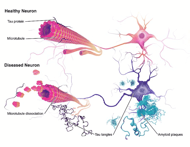 Doença neuronal na doença de Alzheimer 