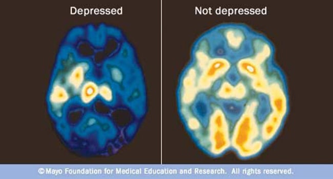 Is Mental Illness Genetic?  Decode your DNA and learn your risks!