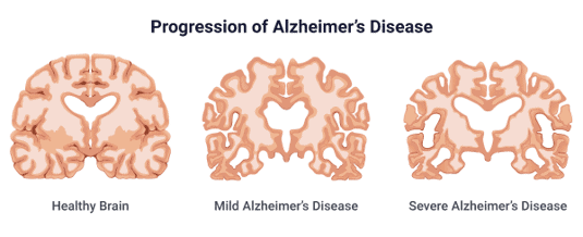 Is Alzheimers genetic? Alzheimer's disease progression shown as an illustration 