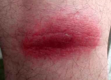 A localized case of inflammation