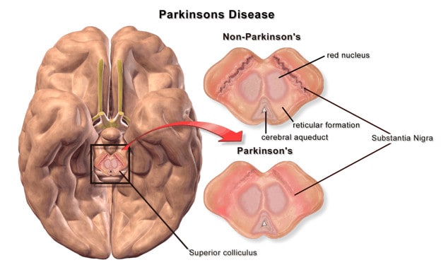 Non-Parkinson's and Parkinson's brain