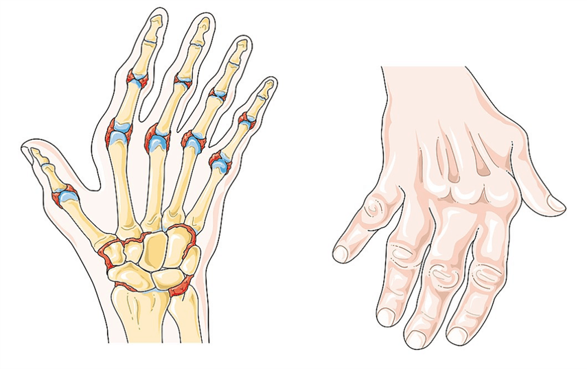 A hand demonstrating signs of rheumatoid arthritis