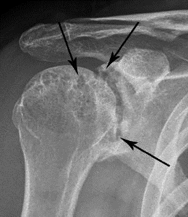 An x-ray of rheumatoid arthritis in a shoulder