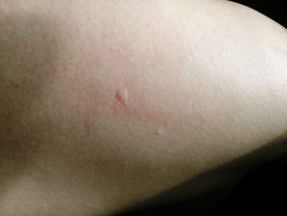 Inflammation caused by an insect bite