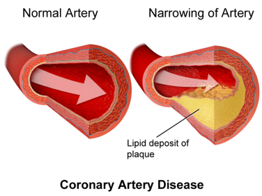 Home cholesterol tests can tell if there is too much fat in your arteries