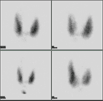 A thyroid scan