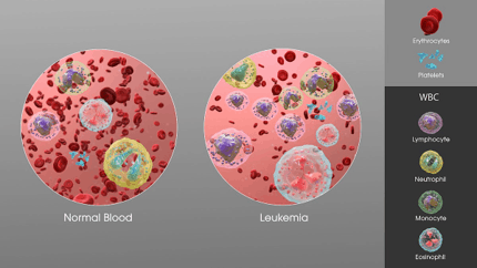 The changes that occur in white blood cells during blood cancer.