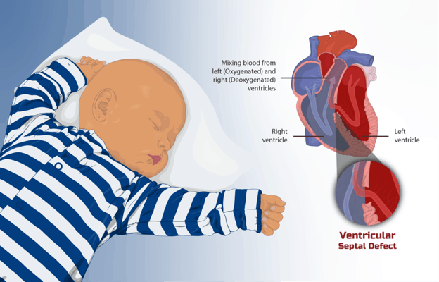 Example of a congenital defect