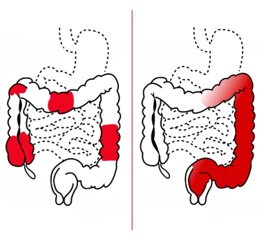 Inflamed areas in Crohn's disease and ulcerative colitis