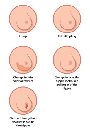 Symptoms of breast cancer