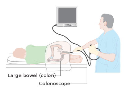 A colonscopy procedure