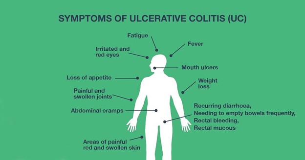 Symptoms of ulcerative colitis