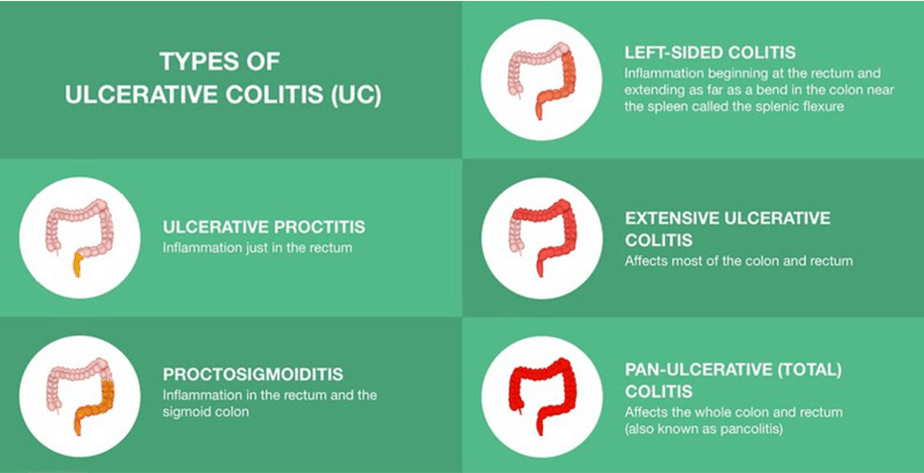 Types of ulcerative colitis