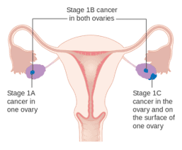 Stage 1 ovarian cancer