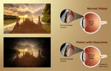Vision differences with and without glaucoma.