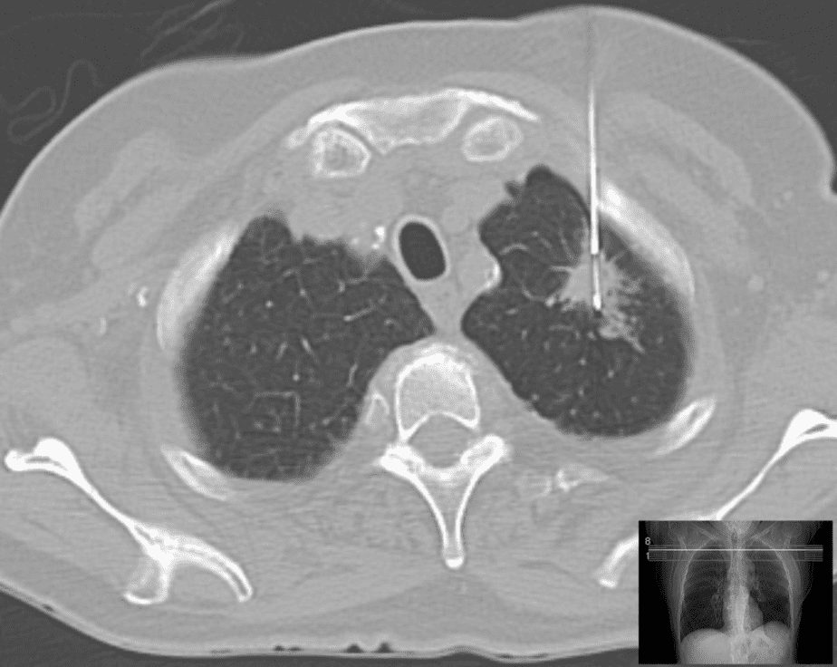 Lung biopsy guided by computertomography