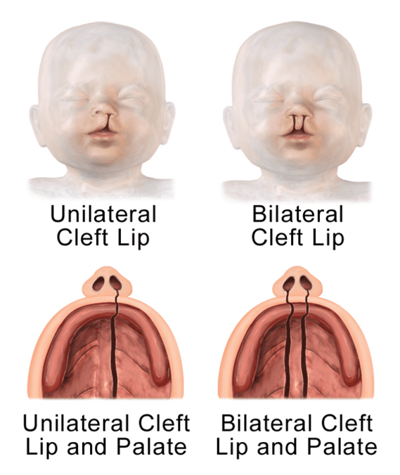 Unilateral and bilateral cleft lip and palate