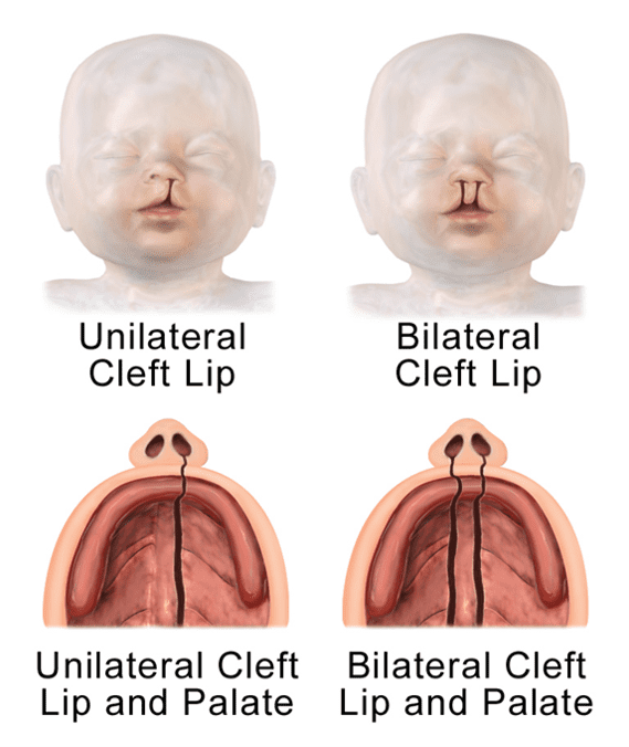 شکاف لب و کام یک طرفه و دو طرفه