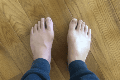 Comparison of gout with a healthy toe. 