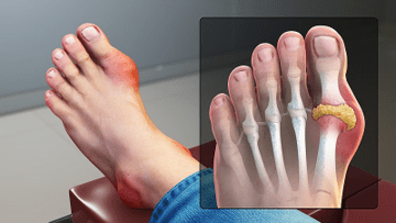 Signs and symptoms of gout