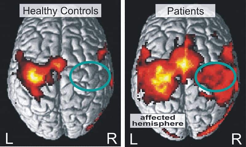 Brain images of a healthy and stroke patient