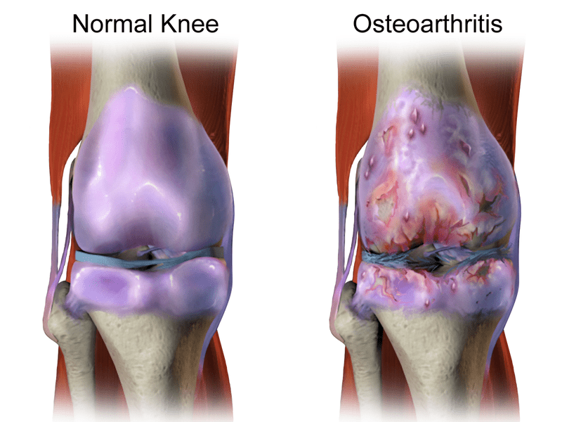 A comparison of a normal and osteoarthritis knee