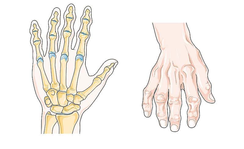 تغییرات در دست ناشی از این بیماری