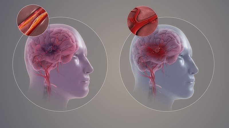 Differences between ischemic and hemorrhagic strokes