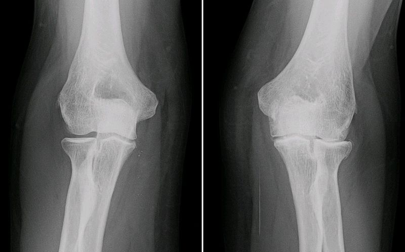 X-ray showing the difference in an osteoarthritis joint