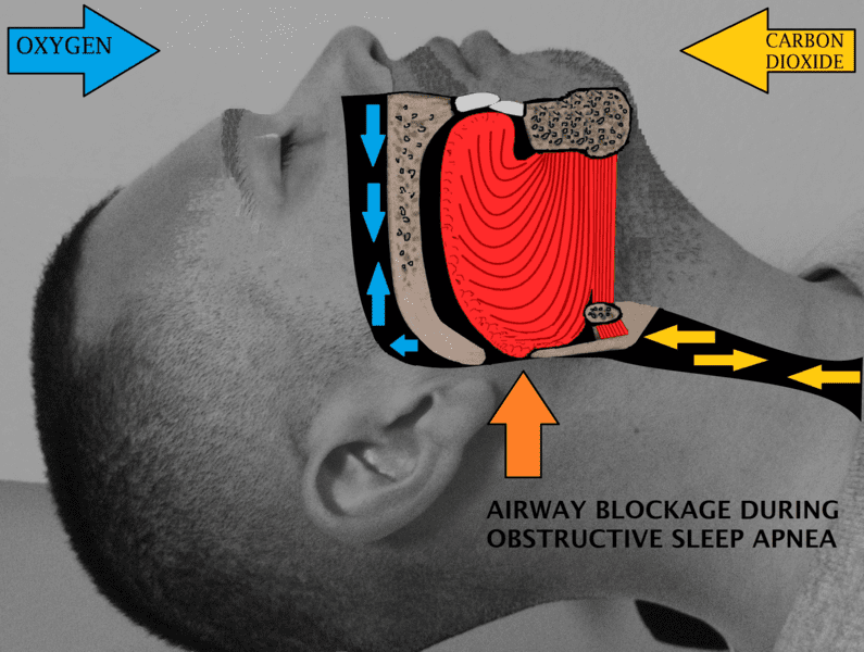 Airway blockage during obstructive sleep apnea