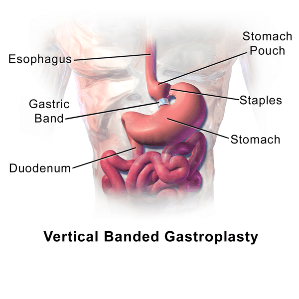 Gastric bypass surgery