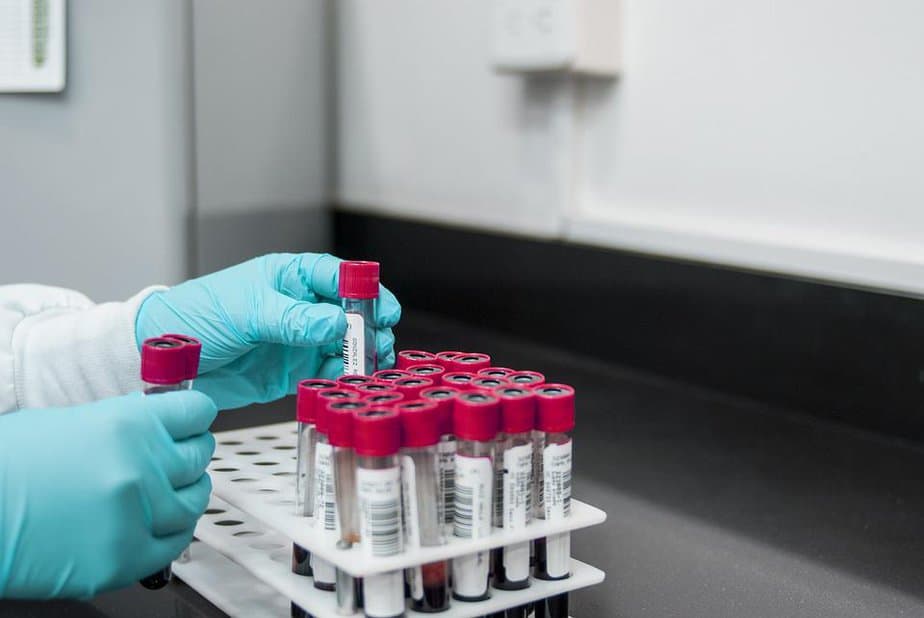 Blood tests are used to measure hormone levels in blood for Addison's disease