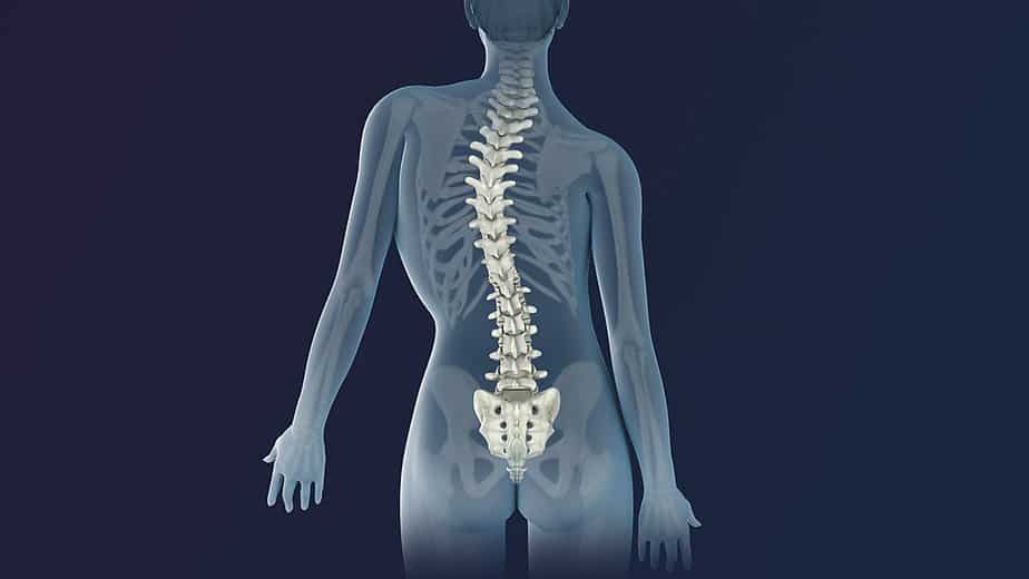 An animation of scoliosis