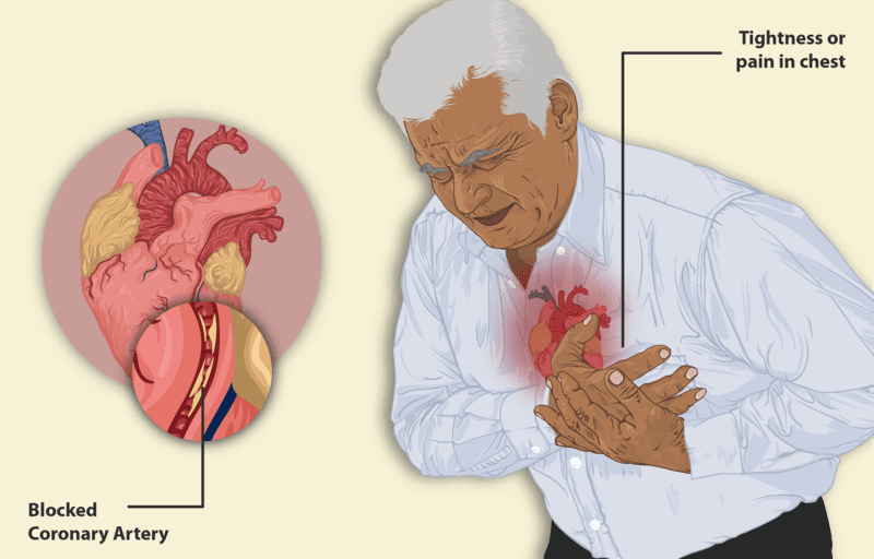 Congestive heart disease during a heart attack