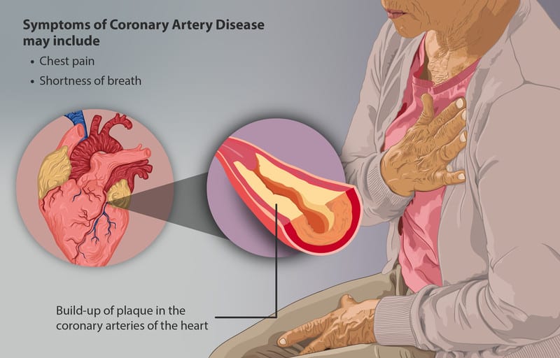 Congestive heart failure in combination with coronary heart disease