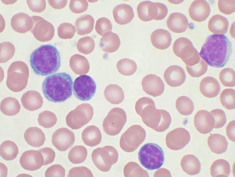 Leukemia cells under a microscope.