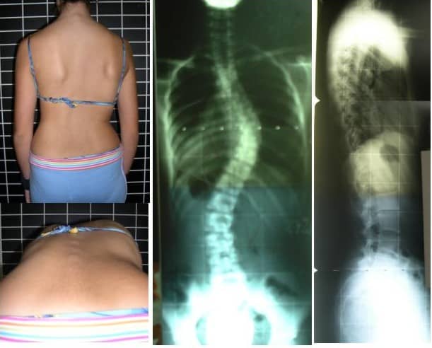 Diagnosing scoliosis