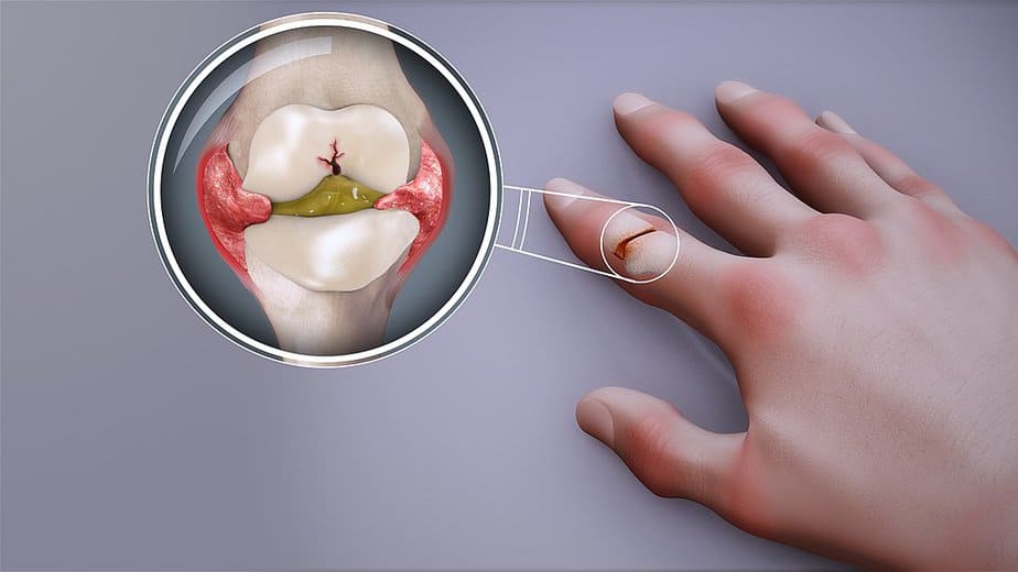 Arthritis - Wikipedia