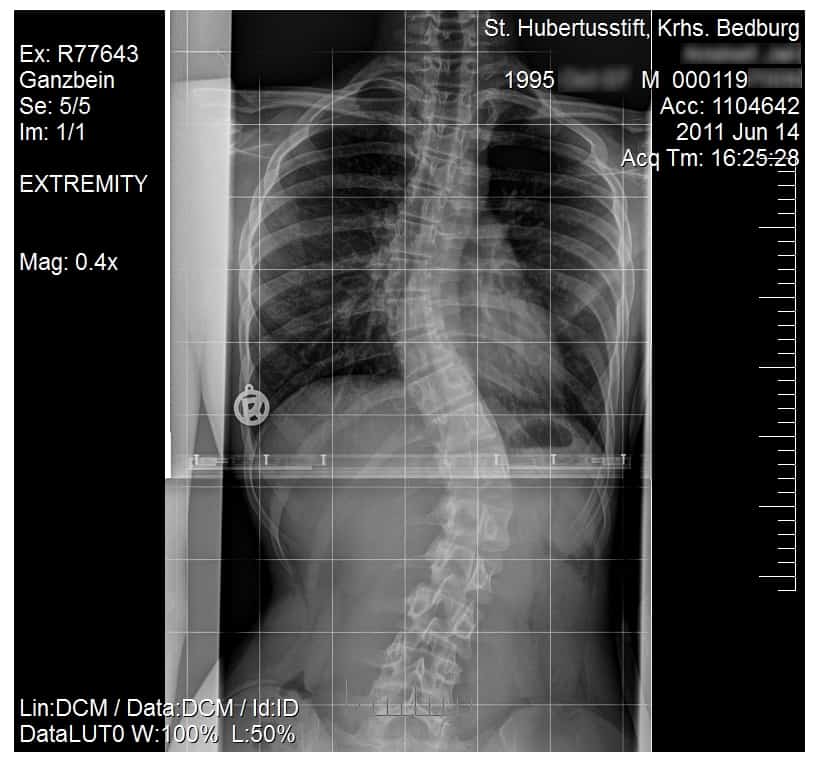 An x-ray of a curved spine