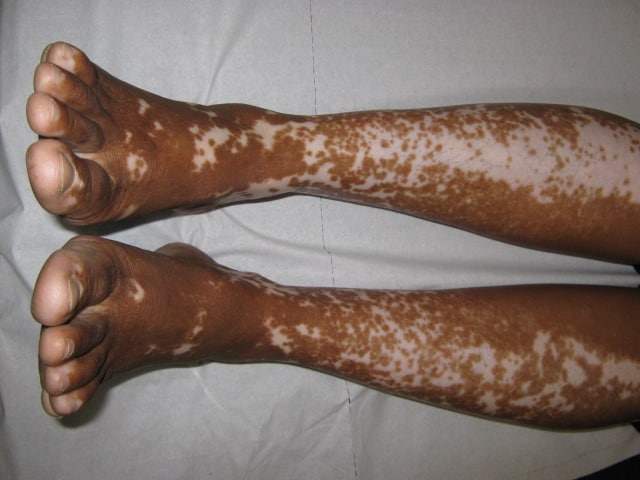 Vitiligo on the legs