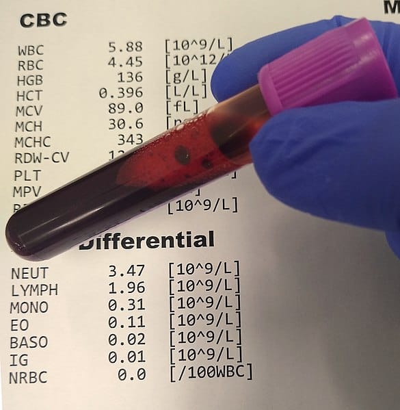 A complete blood count and differential