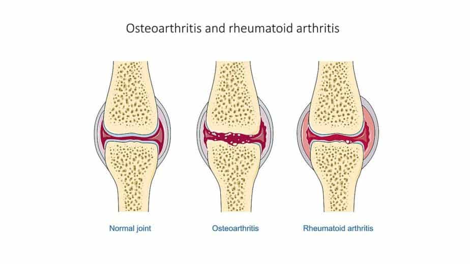 Differences between osteoarthritis and rheumatoid arthritis 