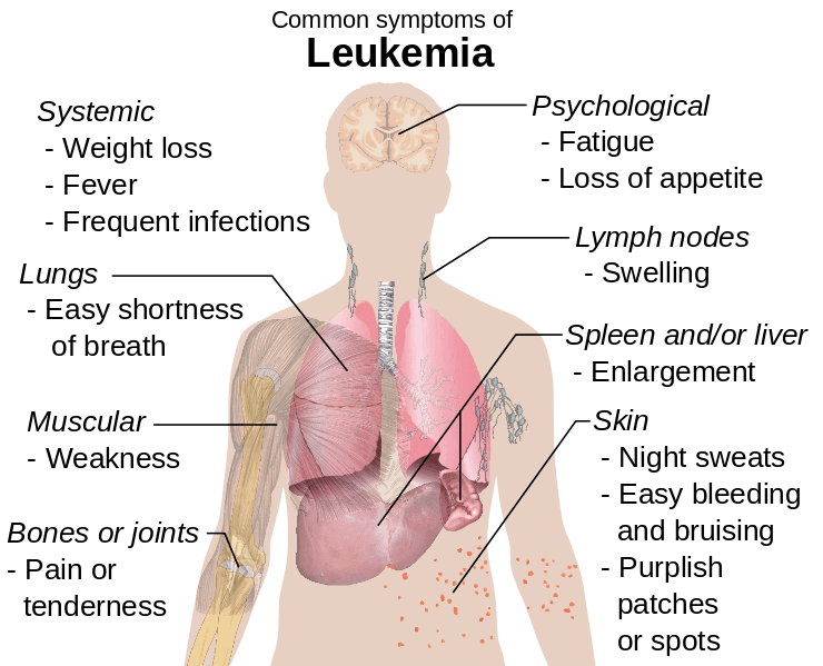 Symptoms of leukemia 